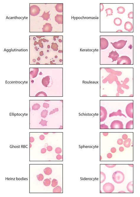 rbc morphology abnormal results